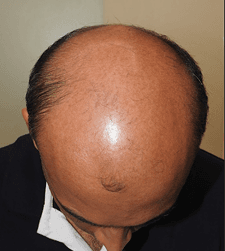 Before treatment