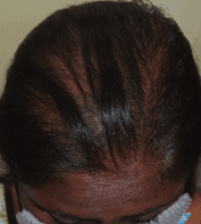 Before treatment