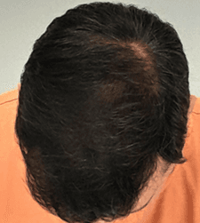 After treatment