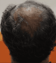 Before treatment