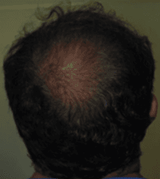 After treatment