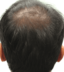 After treatment