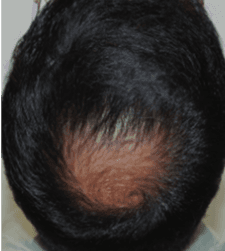 Before treatment