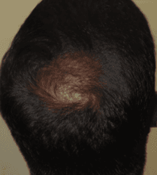 After treatment