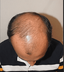 After treatment