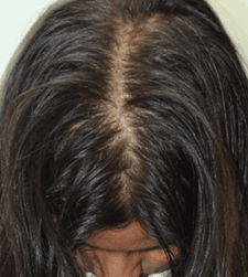 After treatment