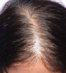 Before treatment