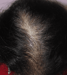 After treatment