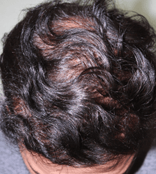 Before treatment