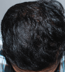 After treatment