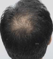 Before treatment