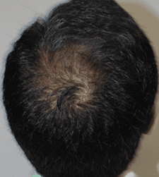 After treatment