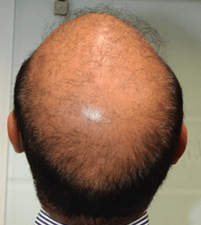 Before treatment