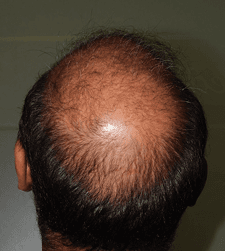 After treatment