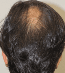 Before treatment