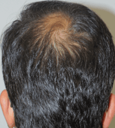 After treatment