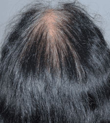 After treatment
