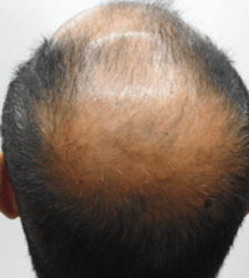 Before treatment