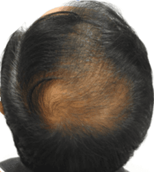 After treatment