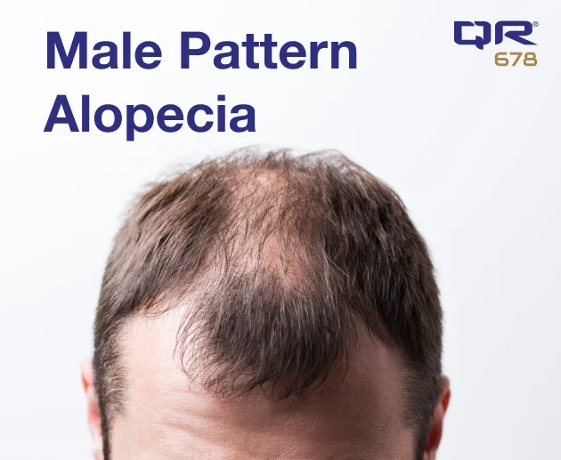 Male Pattern Alopecia: What is it and how to treat it?