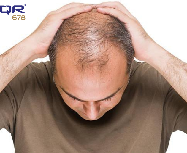 Reverse Male Pattern Baldness Naturally