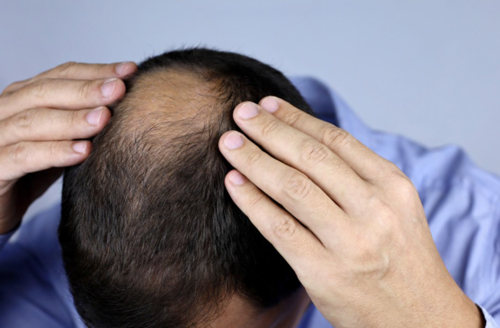 What Is Male Pattern Baldness