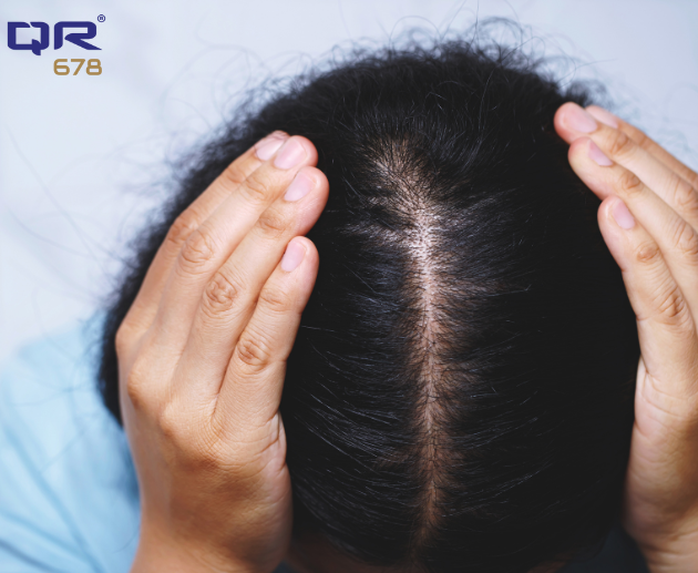 Autoimmune Disease and Hair Loss