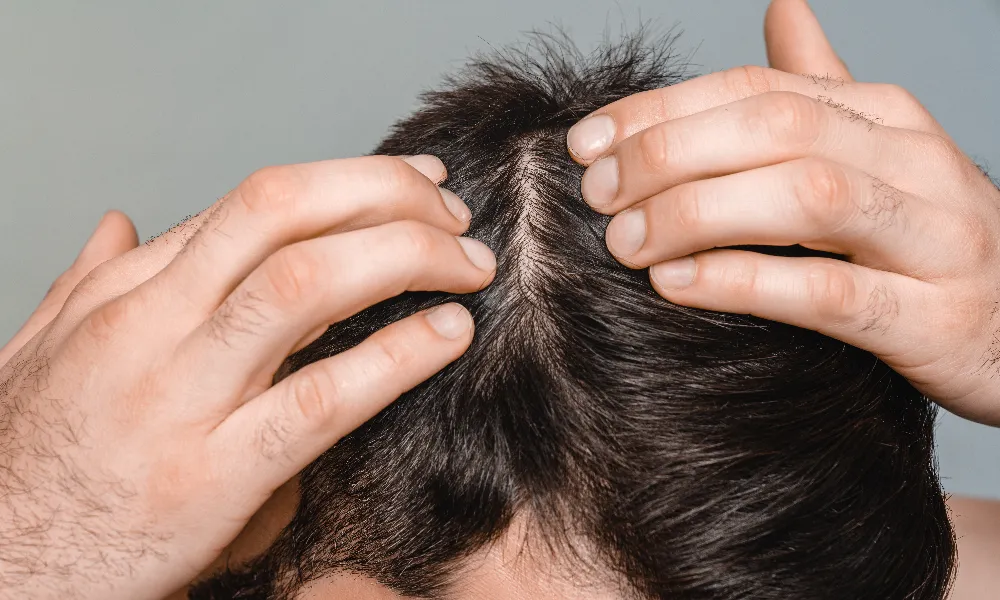 Best Hair Loss Solution for Men