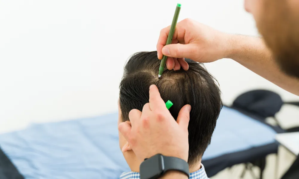 Best Male Hair Restoration