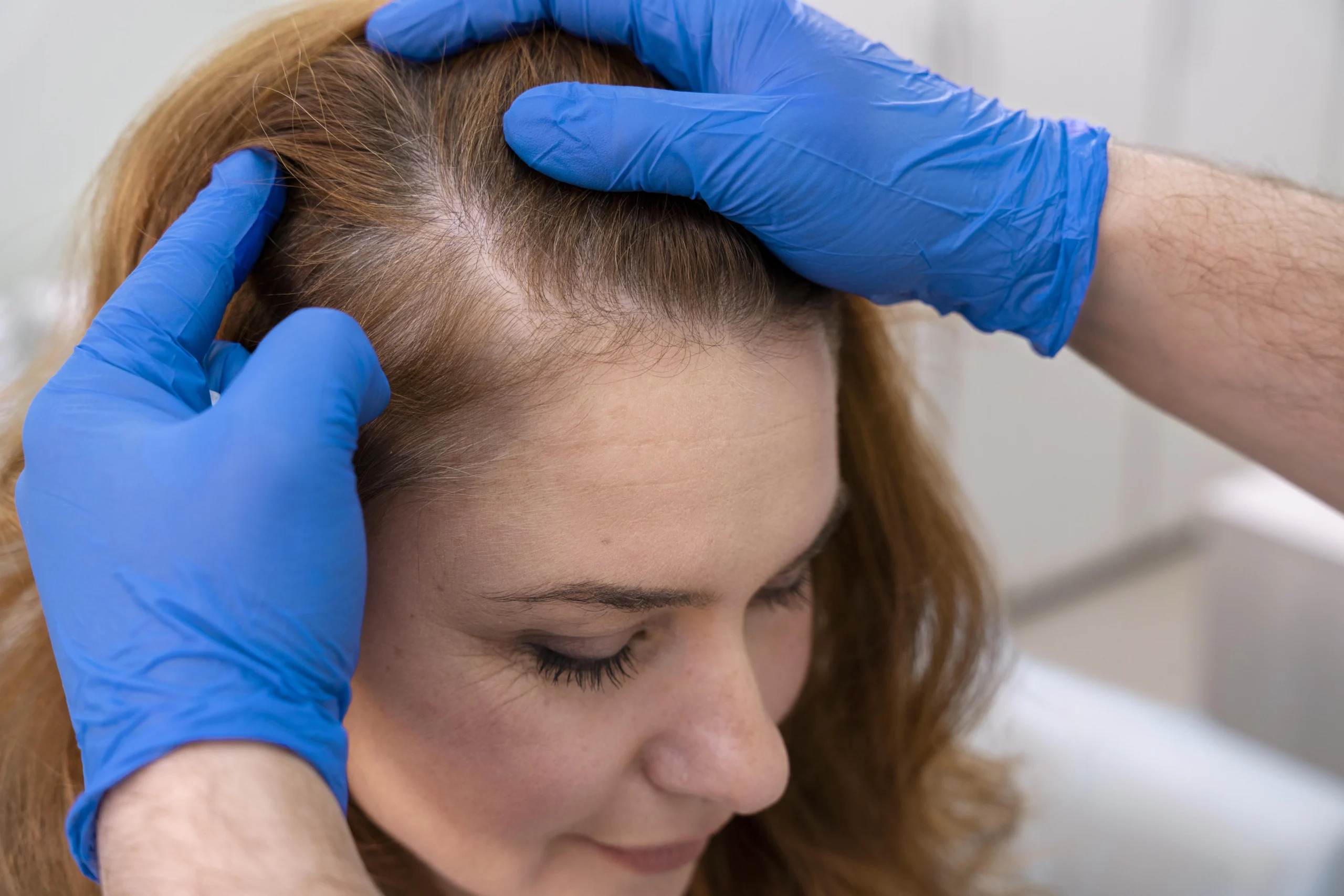 Stem Cell Treatment for Hair Loss