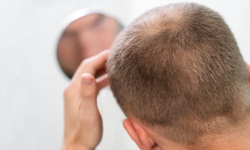 androgenic alopecia treatment